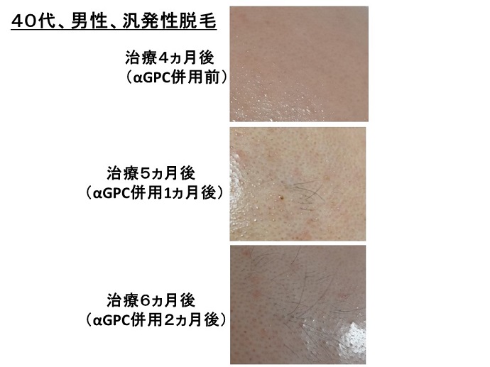 円形脱毛症　病院
